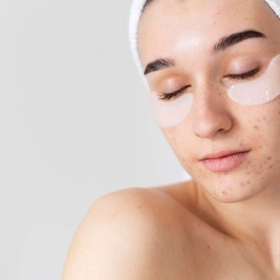 Tratamiento anti-acné en Collado Mediano